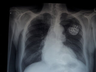 smallest pacemaker