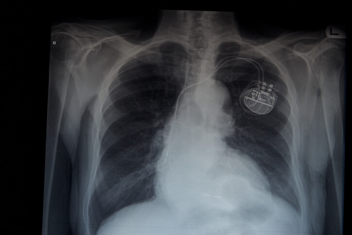 smallest pacemaker